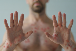 Daniel Díaz Martínez confirma el segundo caso de viruela del mono en la capital del estado Daniel Díaz Martínez confirma el segundo caso de viruela del mono en la capital del estado