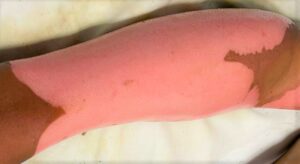 SSG informa lesionado por uso indebido de pirotecnia. SSG informa lesionado por uso indebido de pirotecnia.