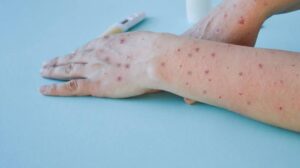 ¿Cuántos casos de viruela del mono se han reportado en México? ¿Cuántos casos de viruela del mono se han reportado en México?