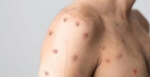 Guanajuato sin casos activos de viruela del mono, pero hay antecedentes: Ligia Arce Padilla titular de la SSG Guanajuato sin casos activos de viruela del mono, pero hay antecedentes: Ligia Arce Padilla titular de la SSG