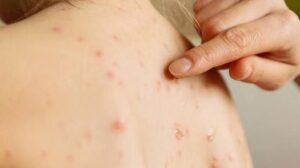 Guanajuato mantiene control sobre casos de sarampión: Secretaría de Salud reporta alta cobertura de vacunación Guanajuato mantiene control sobre casos de sarampión: Secretaría de Salud reporta alta cobertura de vacunación