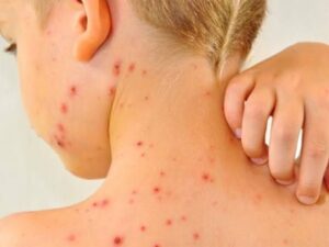 Confirman primer caso de sarampión en Guanajuato tras 30 años; menor de 13 años en León es el afectado Confirman primer caso de sarampión en Guanajuato tras 30 años; menor de 13 años en León es el afectado